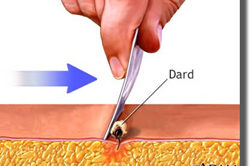 Piqûre de guêpe Piqûre de guêpe